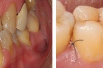 Regeneración de un defecto periodontal más allá del ápice de un molar...