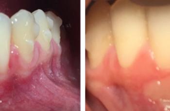 Injerto Gingival Libre. A propósito de un caso.