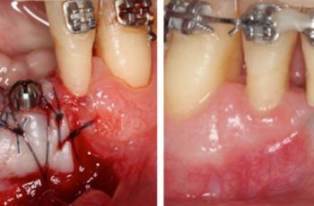 Injerto gingival libre alrededor de implantes dentales. A propósito de un...
