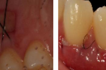 Injerto de tejido conectivo para cubrimiento radicular en 4º cuadrante