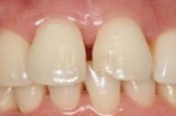 Efectividad del Tratamiento en Periodontitis Agresiva