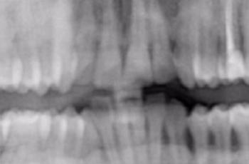 Tratamiento de un paciente con periodontitis crónica I