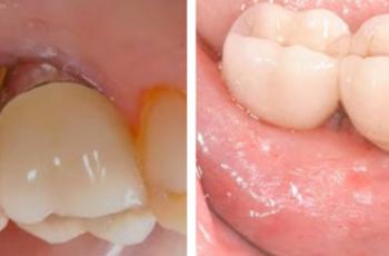 Tratamiento de un paciente con periimplantitis
