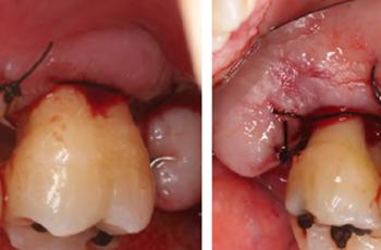 Tratamiento de un paciente con periodontitis crónica II
