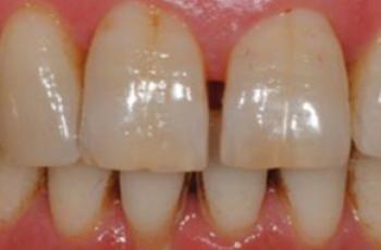 Tratamiento de un paciente con periodontitis crónica moderada generalizada