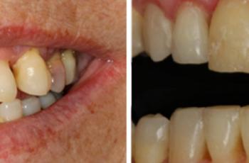 Tratamiento multidisciplinar de un paciente con Periodontitis avanzada...