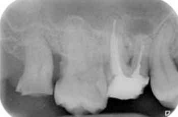 Lesión endo-periodontal combinada verdadera en raíz mesiovestibular de...