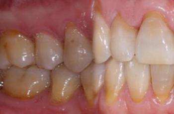Tratamiento de Recesiones Gingivales Clase III de Miller mediante técnica...