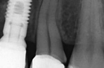 Terapia mucogingival en implantes: corrección de las secuelas mucosas de...