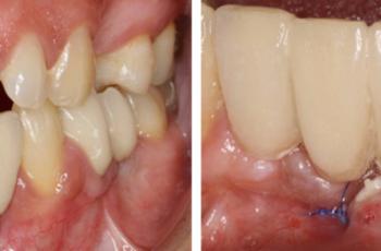 Injerto de tejido conectivo en el tratamiento de defectos mucosos...