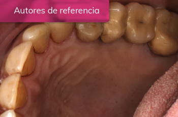 EVOLUCIÓN DE LA CICATRIZACIÓN EN EL TRATAMIENTO DE EXODONCIA