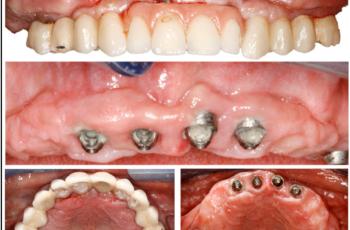 Etiología, diagnóstico y tratamiento de la periimplantitis: Caso...