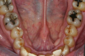 Periodontitis, estadio II, grado A