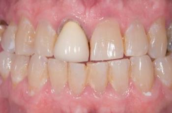 Extrusión quirúrgica