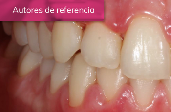 TRATAMIENTO DE PACIENTE CON ENFERMEDAD PERIODONTAL NECROSANTE