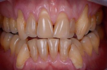 Tratamiento periodontal completo de un paciente con periodontitis estadio...