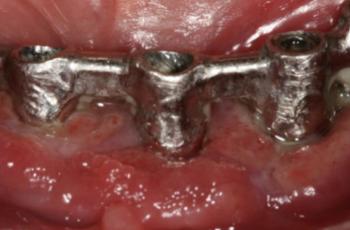 Peri-implantitis