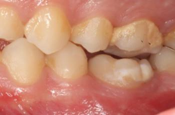 Aplicación clínica de la tecnología digital 3D para el Autotrasplante...