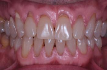 Tratamiento de periodontitis estadio III grado C y de condiciones...