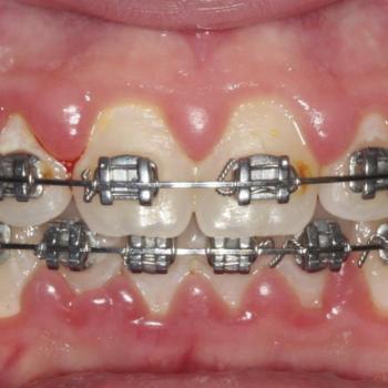 Gingivitis asociada a placa en...