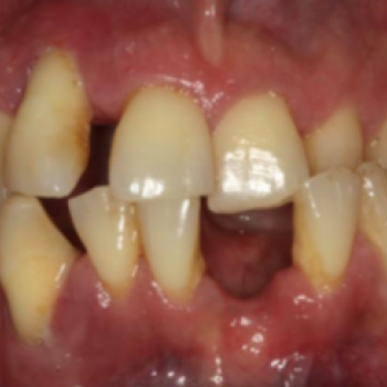 Tratamiento de un diente uniradicular...