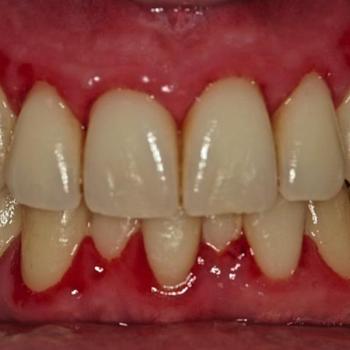 Periodontitis Como Manifestación de...