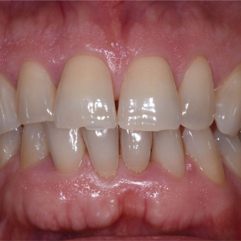 Tratamiento de un defecto intraóseo...