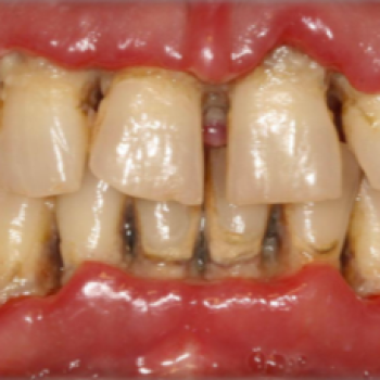 Periodontitis necrosante 