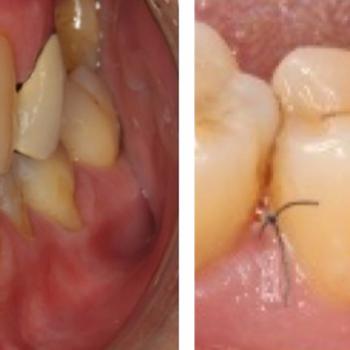 Regeneración de un defecto periodontal...