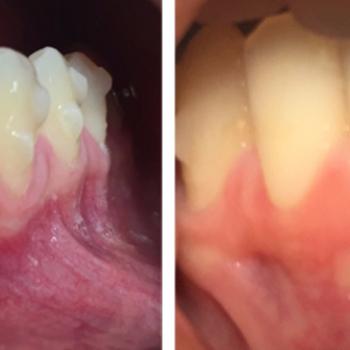 Injerto Gingival Libre. A propósito de...