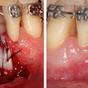 Injerto gingival libre alrededor de...