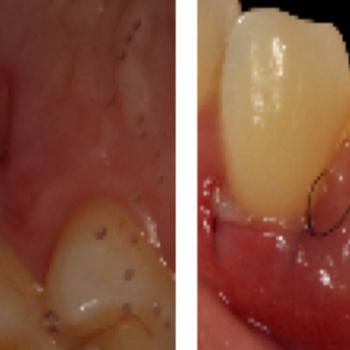 Injerto de tejido conectivo para...