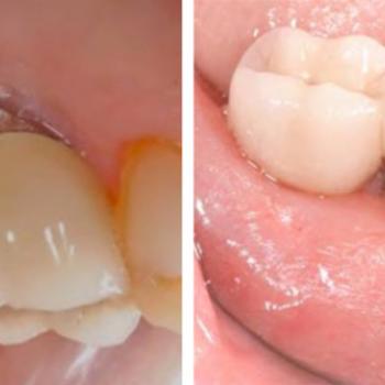 Tratamiento de un paciente con...