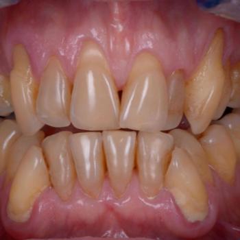 Tratamiento periodontal completo de un...