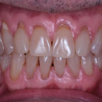 Tratamiento de periodontitis estadio...