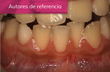 EVOLUCIÓN DE LA CICATRIZACIÓN EN EL TRATAMIENTO DE ORTODONCIA CON...