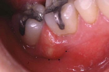 Absceso periodontal