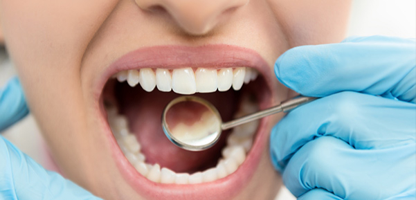 Flapless application of enamel matrix derivative in periodontal retreatment