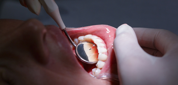 The association between chronic periodontitis and oral Helicobacter pylori: A meta-analysis