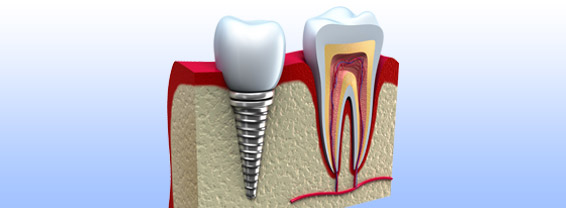 Prevalencia, Diagnóstico y Tratamiento de la periimplantitis