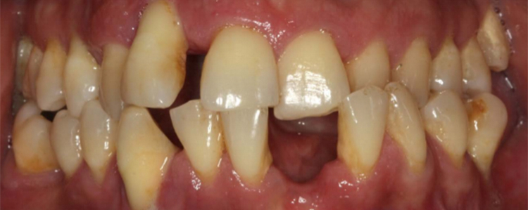 Tratamiento de un diente uniradicular afectado por una lesión endo-periodontal combinada que se extiende más allá del ápice