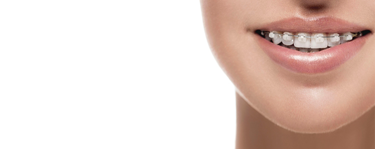 Cuidados periodontales en el paciente con ortodoncia