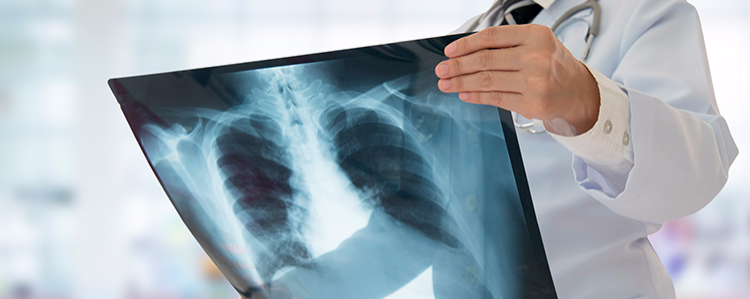 Periodontitis y enfermedad pulmonar obstructiva crónica