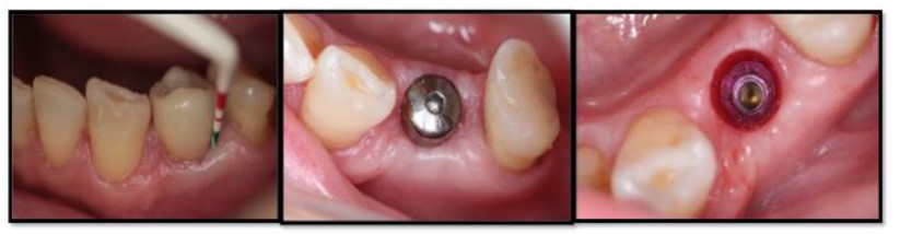 Protocolo de desinfección con láser ER;CR:YSGG y peróxido de hidrógeno al 3% en zonas con infecciones endo-perio con implantes inmediatos postextracción. Seguimiento de casos a tres años 