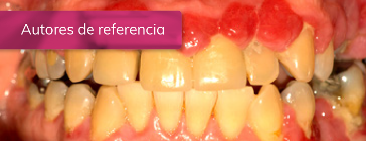 Tratamiento de paciente con periodontitis estadio III : Hiperplasia Gingival Inflamatoria