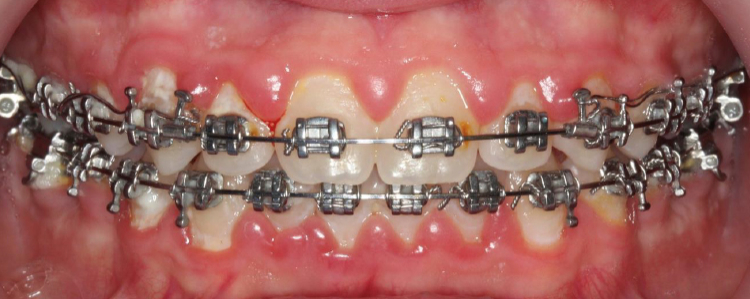 Gingivitis asociada a placa en ortodoncia