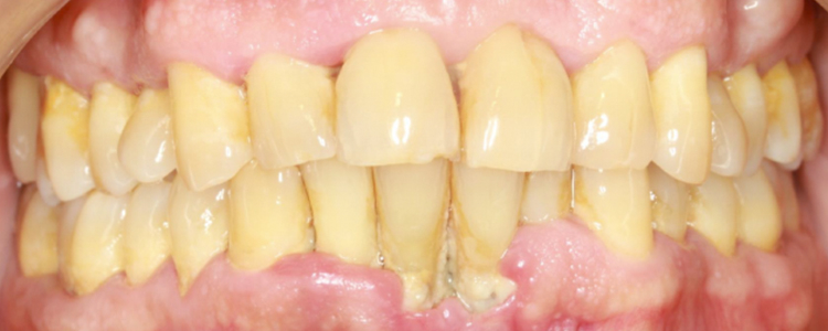 Periodontitis Estadio III, Grado B