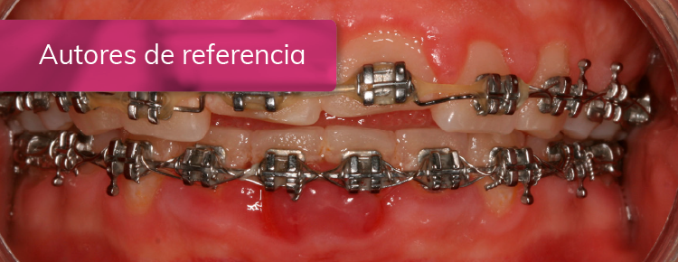 Tratamiento de gingivitis inducida por biofilm dental en un paciente portador de ortodoncia.