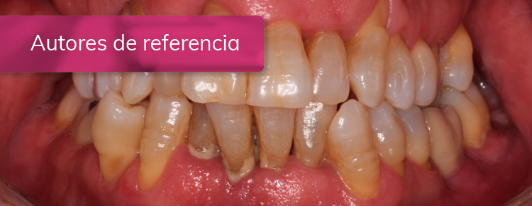 Tratamiento de peri-implantitis y de periodontitis generalizada en estadio III grado C.