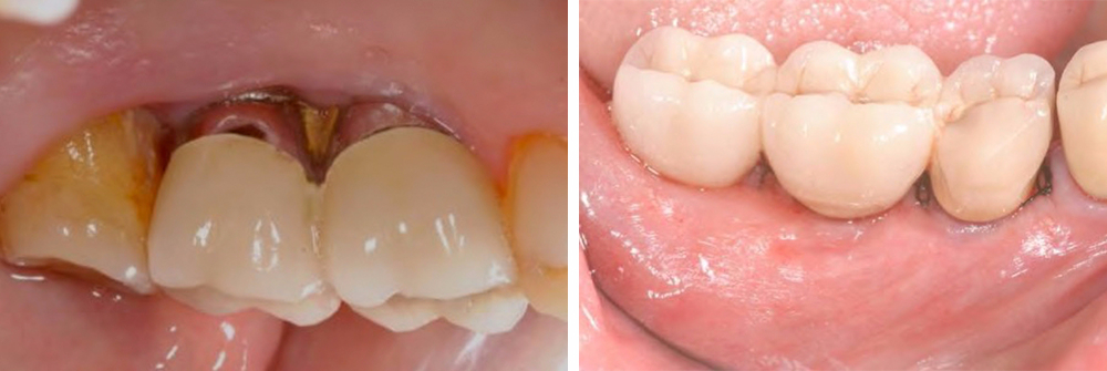 Tratamiento de un paciente con periimplantitis